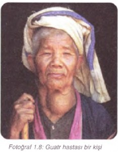 guatr hastası bir kişi