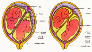 Solda: Yalancı ikizler ya da çift yumurta ikizleri; Sağda: Gerçek ikizler ya da tek yumurta ikizleri.