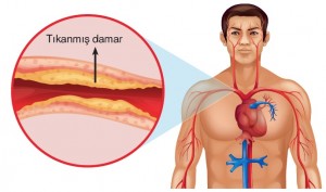 Damar tıkanıklığı