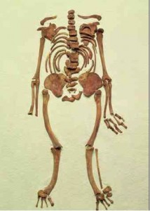 osteomalazi